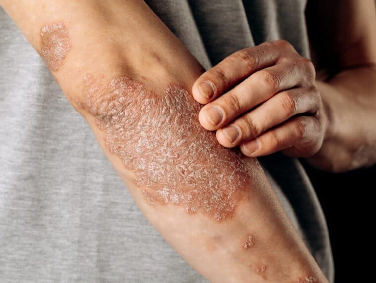 Противогрибковая программа Коралловый Клуб