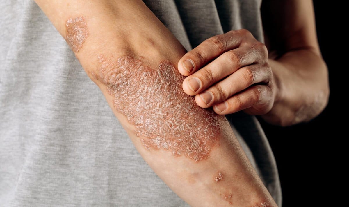 Противогрибковая программа Коралловый Клуб